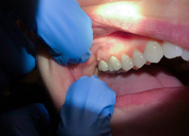 Best Cracked Tooth Emergency Dentist  in Pace, FL
