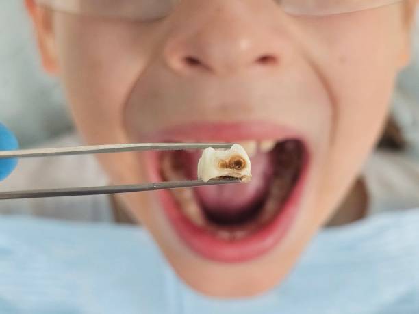 Best Knocked-Out Tooth Emergency  in Pace, FL